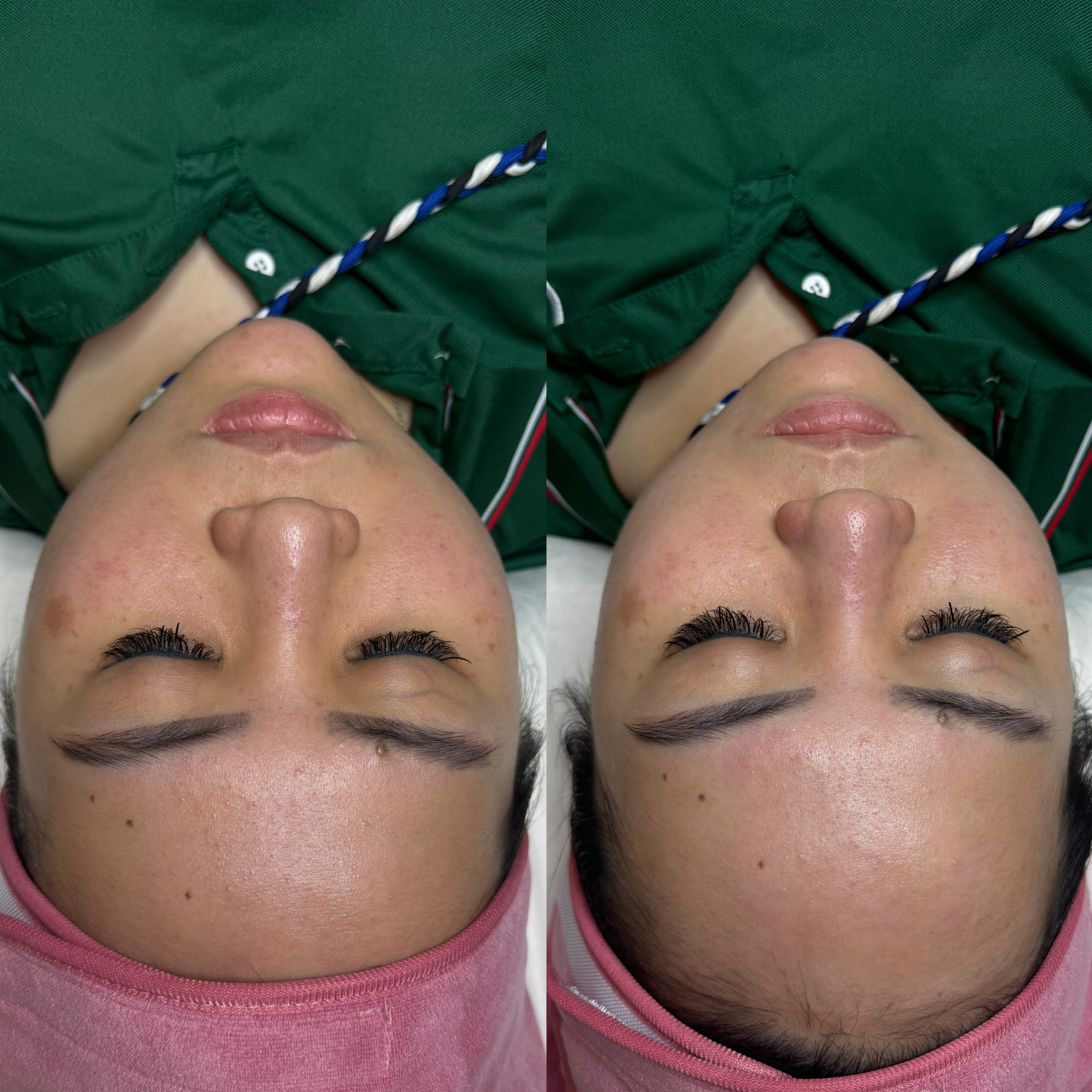 Aqua Peel x BB Glow Facial