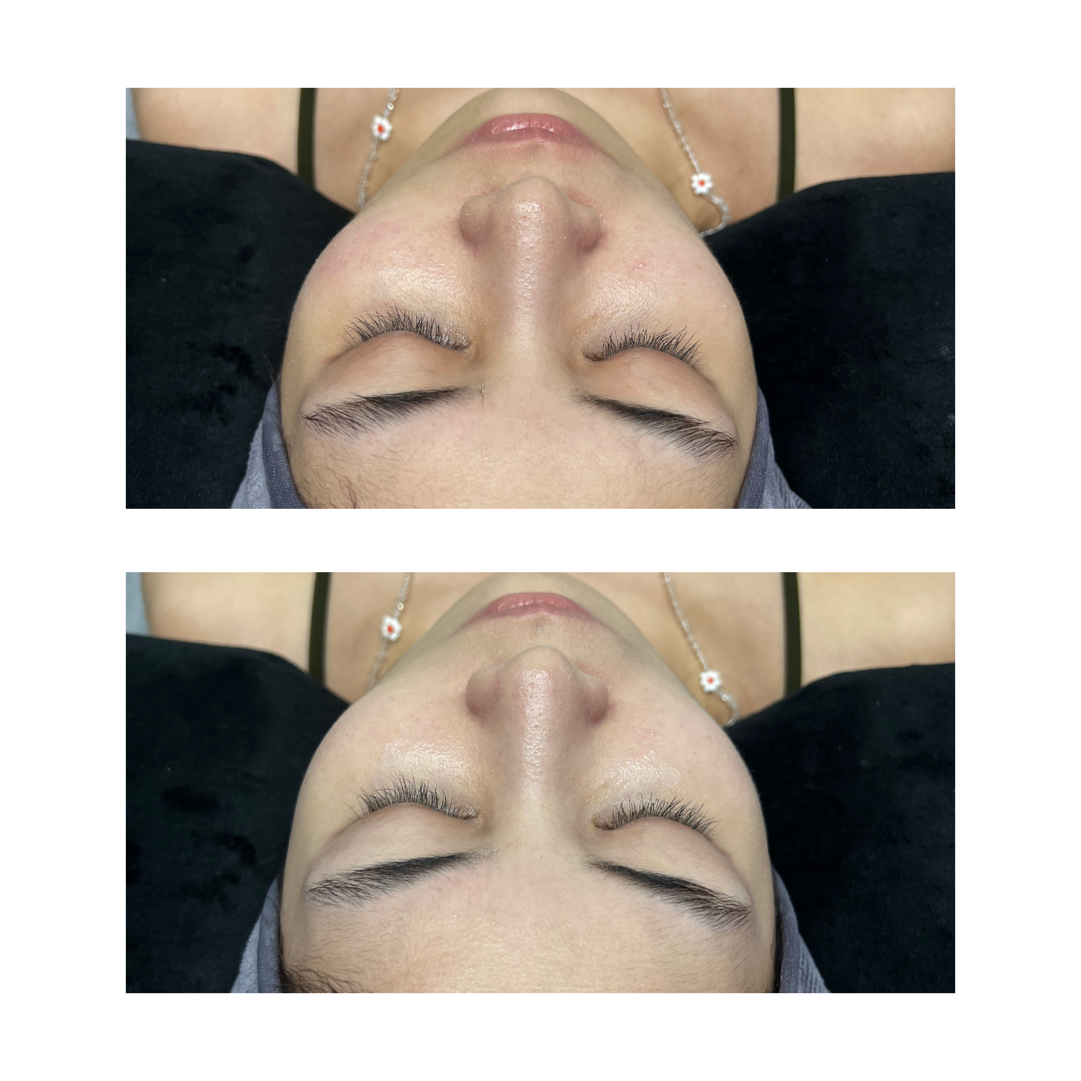 Aqua Peel Facial